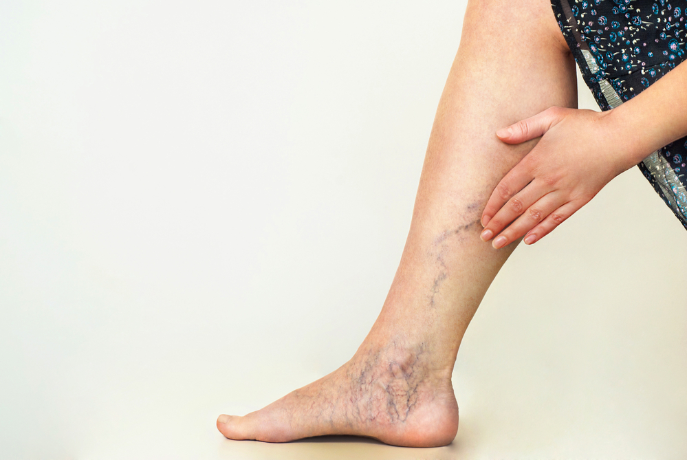 when to seek treatment for varicose veins